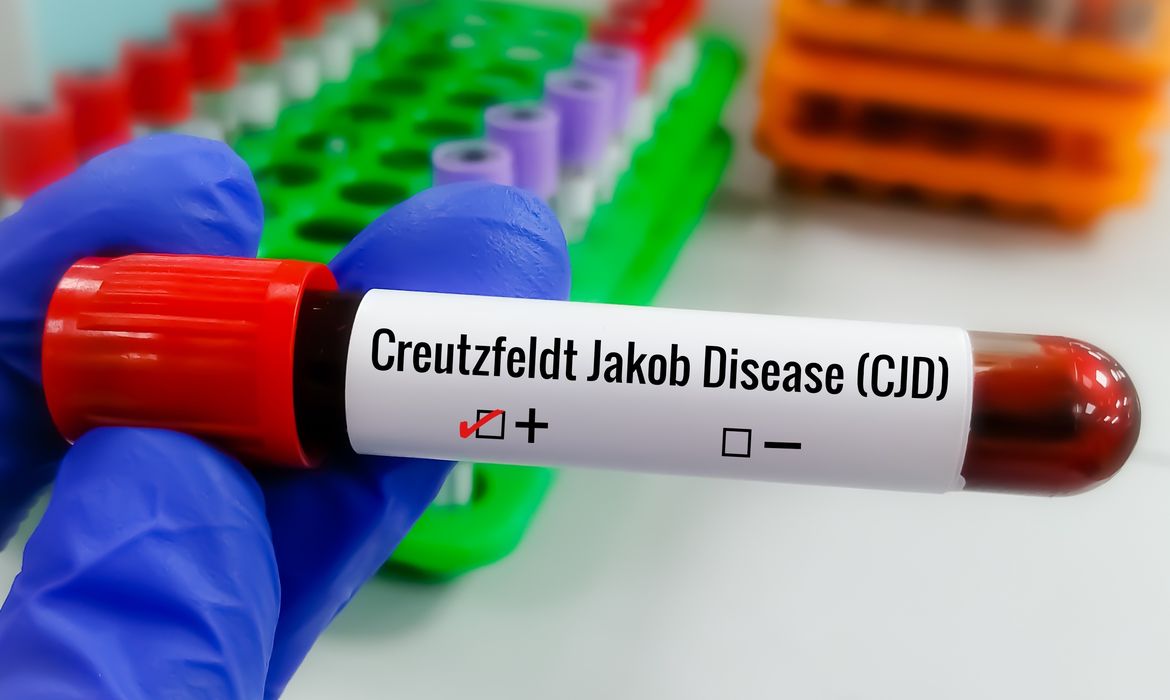 RT-QuIC ajuda no diagnóstico da Creutzfeldt-Jakob