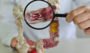 Estudo alerta para avanço de doenças intestinais no Brasil